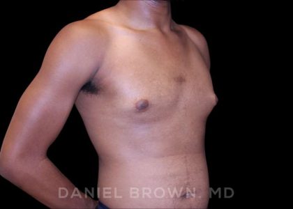 Gynecomastia Before & After Patient #10066