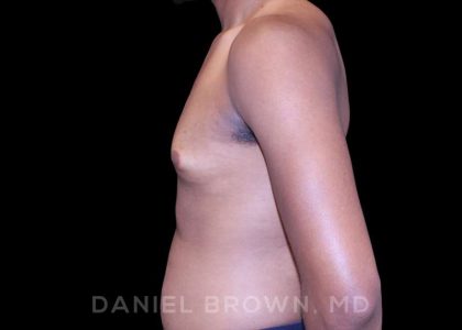 Gynecomastia Before & After Patient #10066
