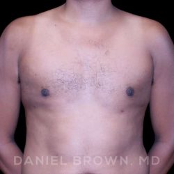 Gynecomastia Before & After Patient #10077