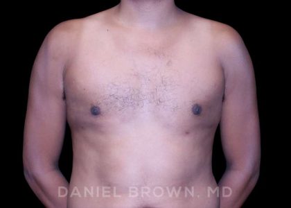 Gynecomastia Before & After Patient #10077