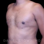 Gynecomastia Before & After Patient #10077