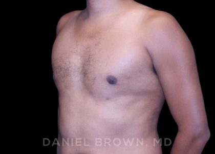 Gynecomastia Before & After Patient #10077