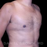 Gynecomastia Before & After Patient #10077