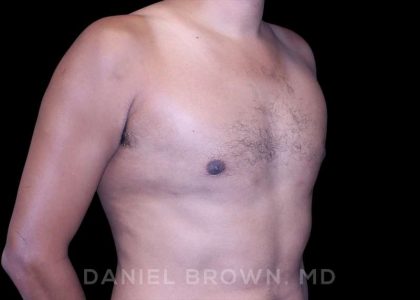 Gynecomastia Before & After Patient #10077