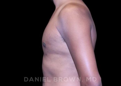 Gynecomastia Before & After Patient #10077