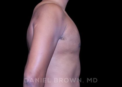 Gynecomastia Before & After Patient #10077