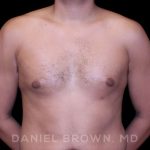 Gynecomastia Before & After Patient #10077