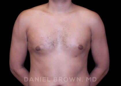 Gynecomastia Before & After Patient #10077