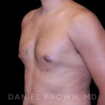 Gynecomastia Before & After Patient #10077