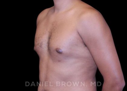 Gynecomastia Before & After Patient #10077