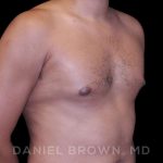 Gynecomastia Before & After Patient #10077
