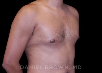 Gynecomastia Before & After Patient #10077