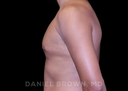 Gynecomastia Before & After Patient #10077