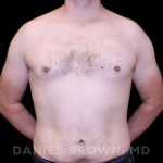 Gynecomastia Before & After Patient #10088