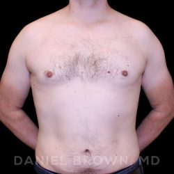 Gynecomastia Before & After Patient #10088