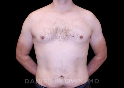 Gynecomastia Before & After Patient #10088
