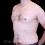 Gynecomastia Before & After Patient #10088