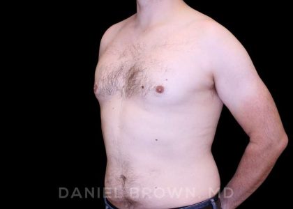 Gynecomastia Before & After Patient #10088