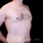 Gynecomastia Before & After Patient #10088