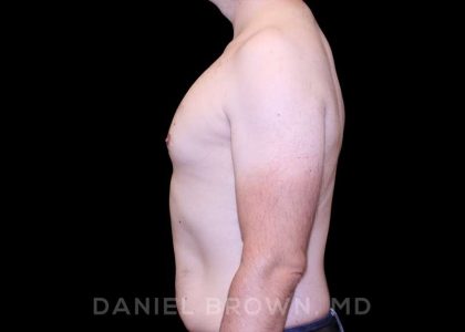 Gynecomastia Before & After Patient #10088