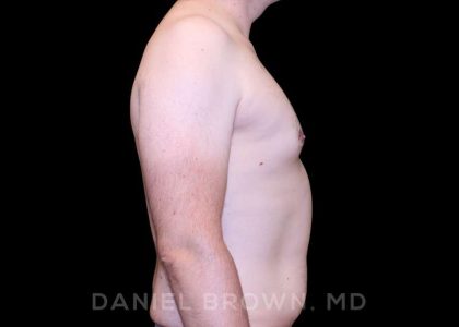Gynecomastia Before & After Patient #10088