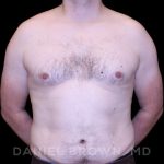 Gynecomastia Before & After Patient #10088