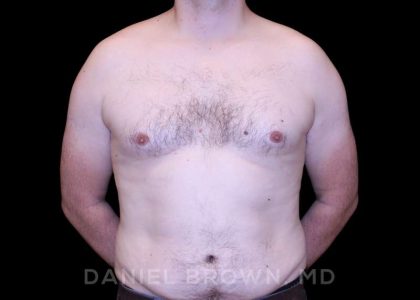 Gynecomastia Before & After Patient #10088