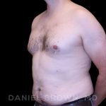 Gynecomastia Before & After Patient #10088