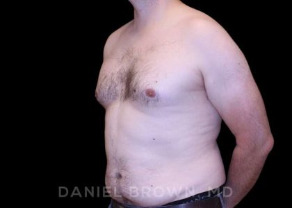 Gynecomastia Before & After Patient #10088