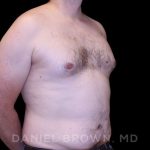 Gynecomastia Before & After Patient #10088