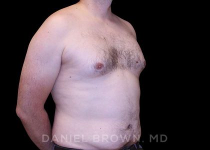 Gynecomastia Before & After Patient #10088