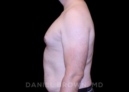 Gynecomastia Before & After Patient #10088