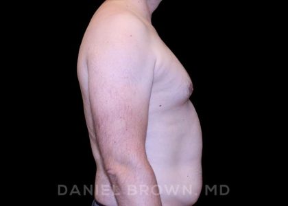 Gynecomastia Before & After Patient #10088