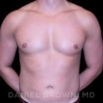 Gynecomastia Before & After Patient #10099
