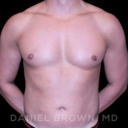 Gynecomastia Before & After Patient #10099