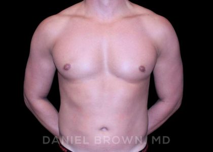 Gynecomastia Before & After Patient #10099
