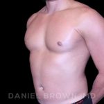 Gynecomastia Before & After Patient #10099