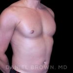 Gynecomastia Before & After Patient #10099