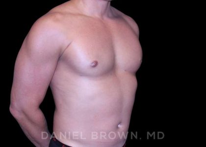 Gynecomastia Before & After Patient #10099