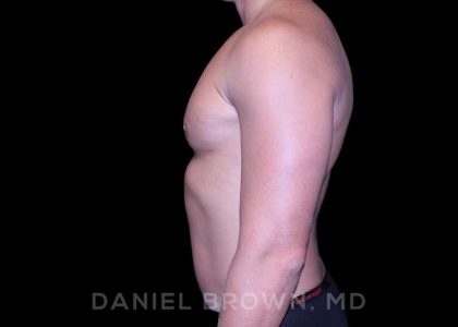 Gynecomastia Before & After Patient #10099