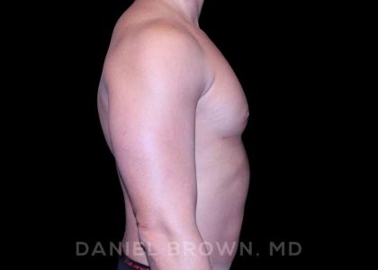 Gynecomastia Before & After Patient #10099