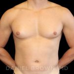 Gynecomastia Before & After Patient #10099