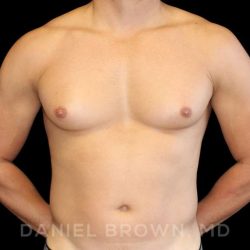 Gynecomastia Before & After Patient #10099