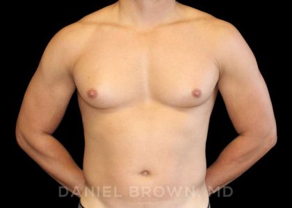 Gynecomastia Before & After Patient #10099