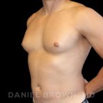 Gynecomastia Before & After Patient #10099