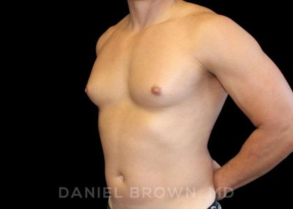 Gynecomastia Before & After Patient #10099