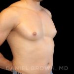 Gynecomastia Before & After Patient #10099