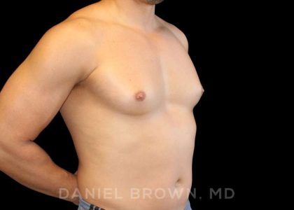 Gynecomastia Before & After Patient #10099