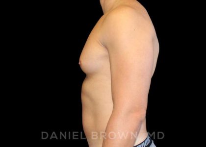 Gynecomastia Before & After Patient #10099