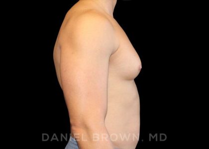 Gynecomastia Before & After Patient #10099